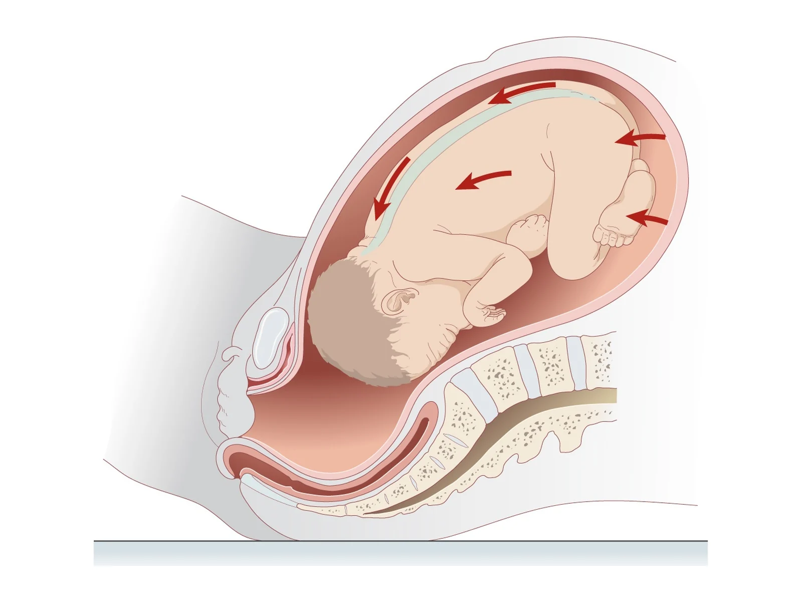 Expulsive forces during labour — Uterine contractions (arrows) push the foetus along its axis towards the pelvic inlet.