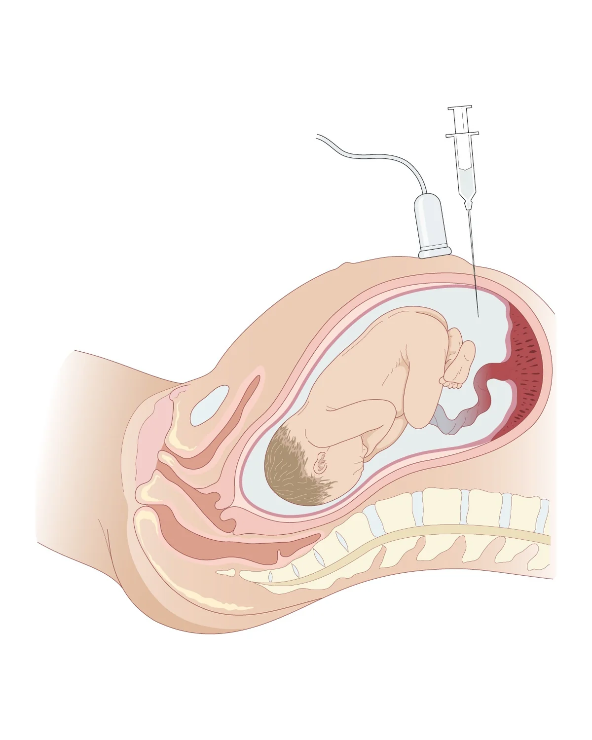 Amniocentèse — Ponction de liquide amniotique à l'aiguille fine, à travers la paroi abdominale, sous contrôle échographique continu.