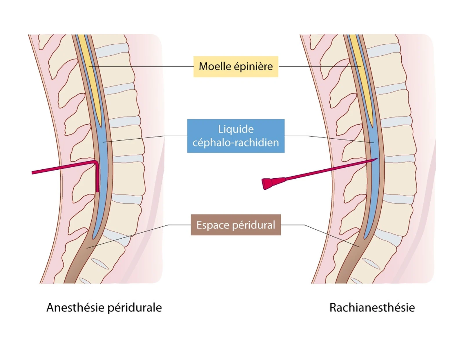 Péridurale et rachianesthésie — La péridurale dépose l'anesthésique dans l'espace péridural ; la rachianesthésie l'injecte dans le liquide céphalo-rachidien.