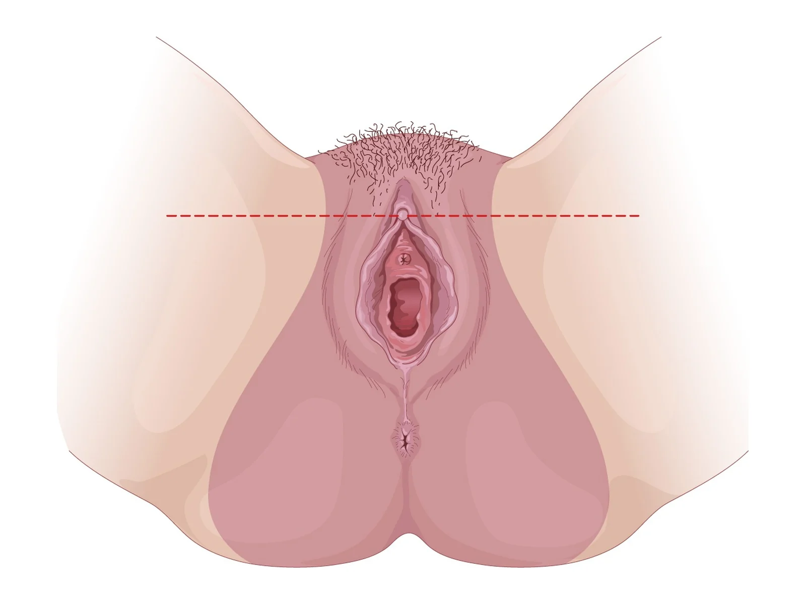 Bandelette transobturatrice : repères — Repère cutané horizontal au niveau du clitoris pour les points d'entrée de la bandelette transobturatrice (TOT).