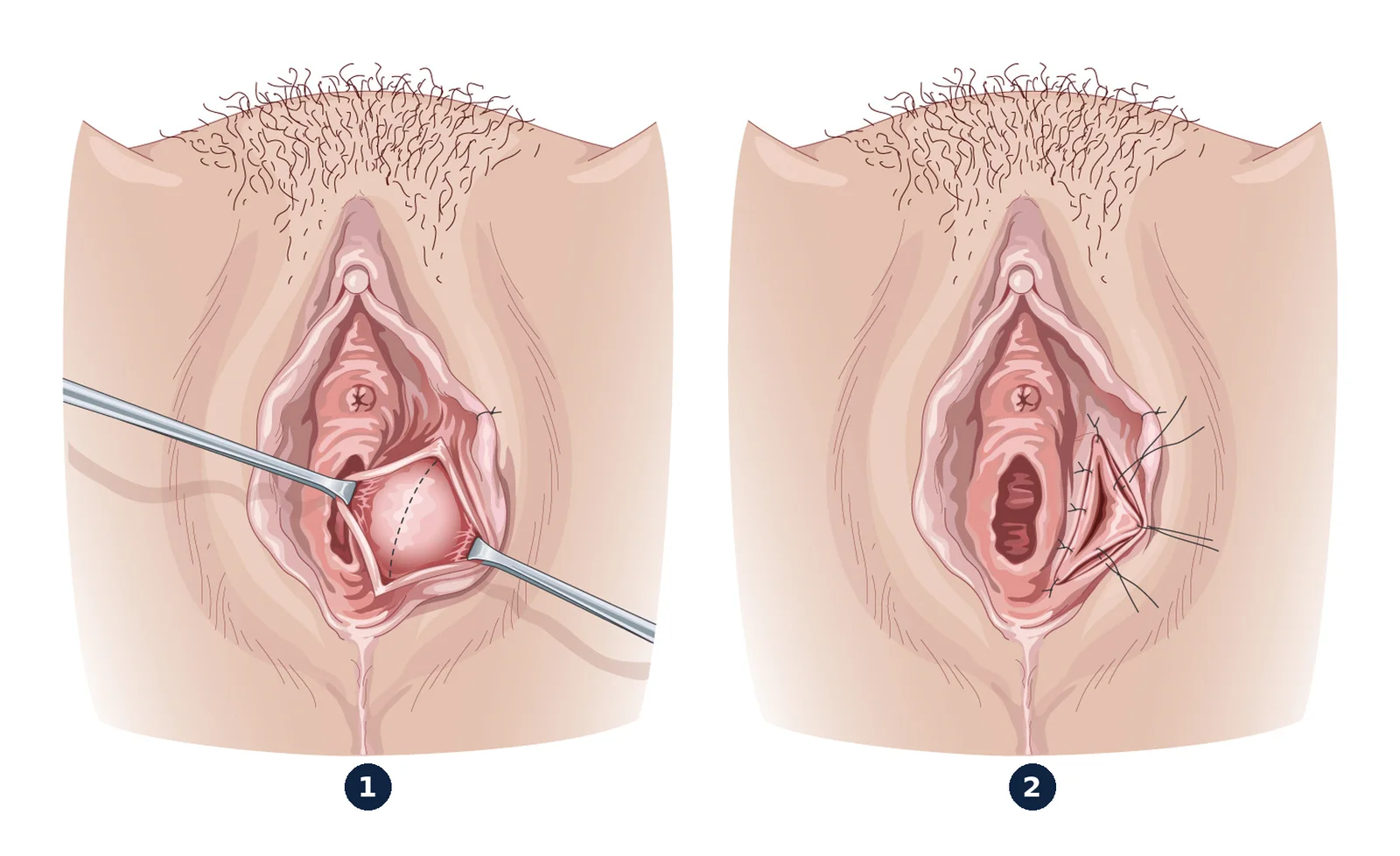 Marsupialisation d'un kyste de Bartholin — La paroi du kyste est incisée et vidée (1), puis ses bords sont suturés à la peau pour laisser un orifice de drainage (2).