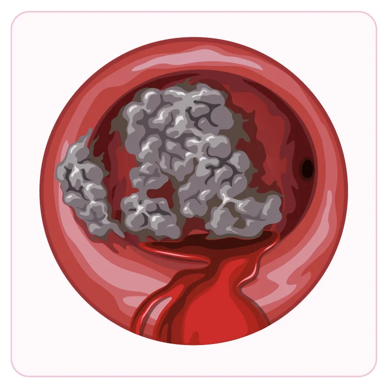 Cancer de l'endomètre vu en hystéroscopie — Lésion irrégulière et saignante de la muqueuse ; la biopsie confirme le diagnostic.