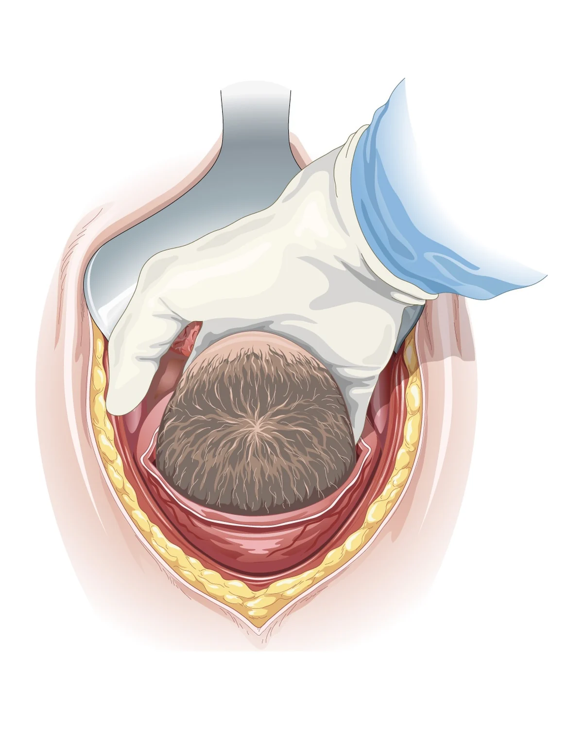 Caesarean section: delivery of the head — The operator's hand slips beneath the foetal head and guides it out through the uterine incision.