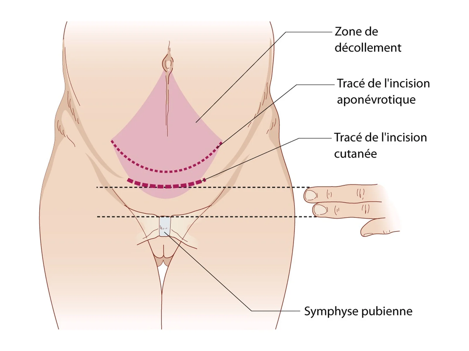 Caesarean section: incision lines — Transverse suprapubic skin incision, fascial incision and area of dissection, two fingerbreadths above the symphysis.