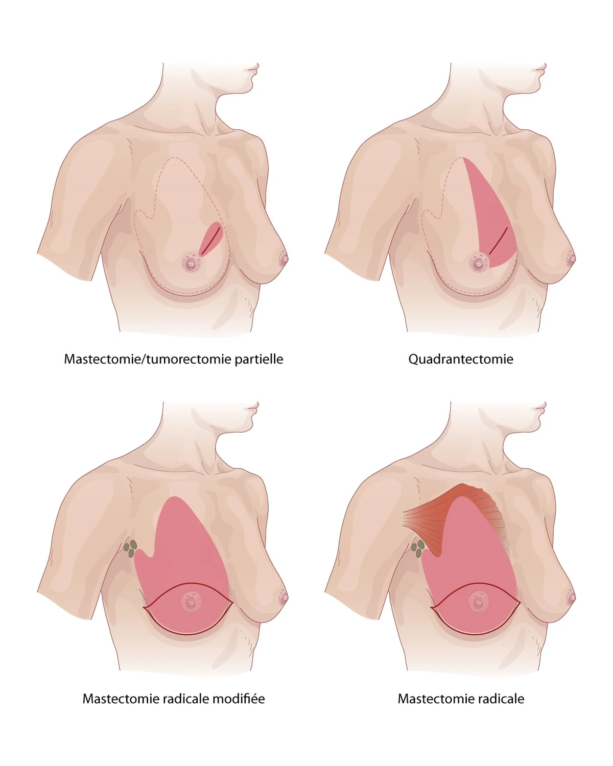 Breast cancer surgery — Lumpectomy, quadrantectomy, modified radical mastectomy and radical mastectomy: extent of excision.