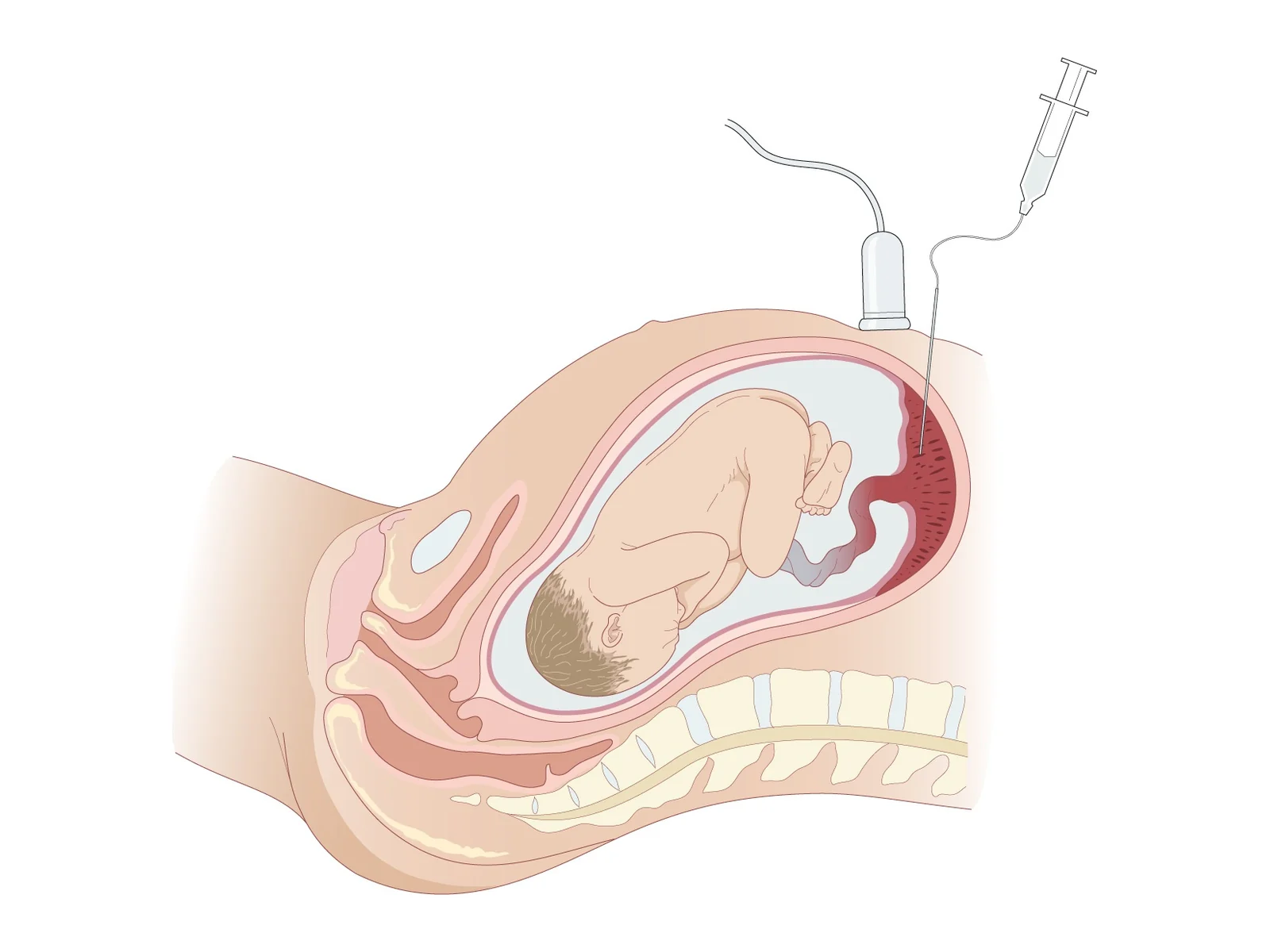 Choriocentèse — Prélèvement de villosités choriales (trophoblaste) à l'aiguille, par voie transabdominale et sous échographie.