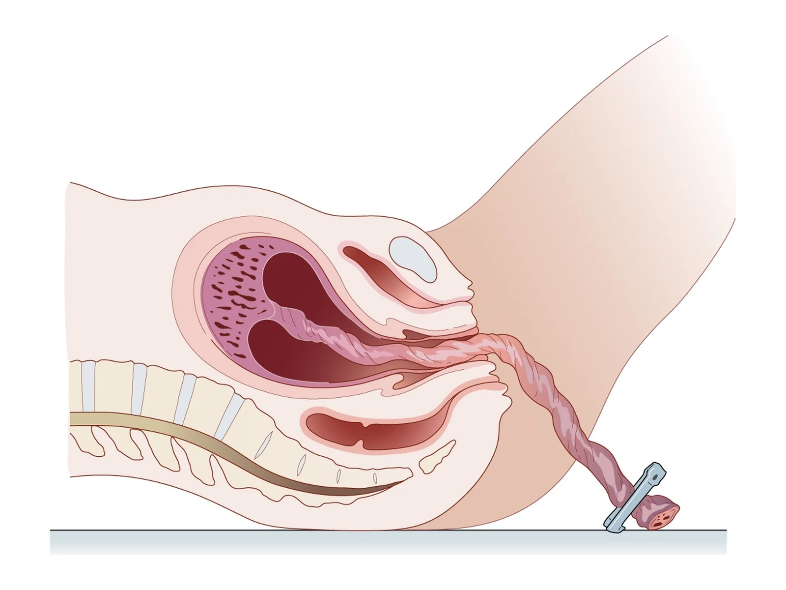 Décollement du placenta — Après la naissance, la rétraction utérine décolle le placenta de la paroi : c'est la première phase de la délivrance.