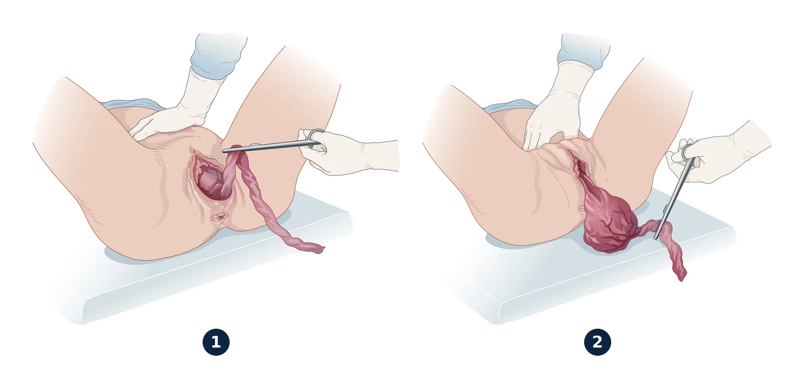 Expulsion du placenta — Le placenta décollé est extrait par traction douce sur le cordon, l'autre main maintenant l'utérus (1), puis recueilli et examiné (2).