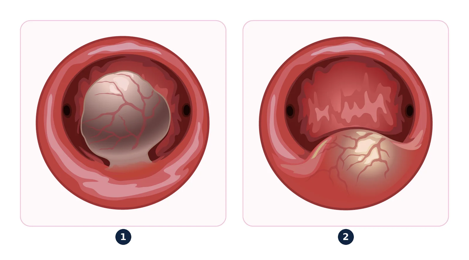 Fibromes sous-muqueux — Vus en hystéroscopie : entièrement dans la cavité (1) ou en partie dans la paroi de l'utérus (2).