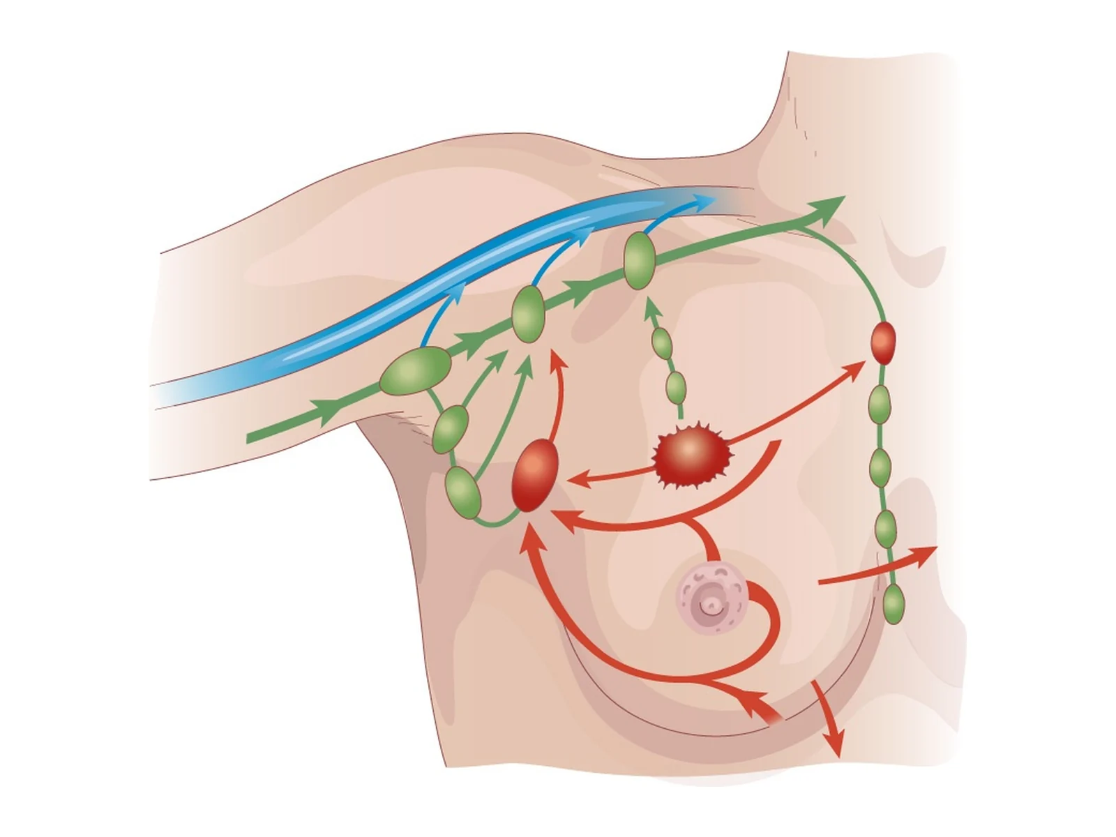Ganglion sentinelle du sein — Drainage lymphatique du sein vers l'aisselle : le ganglion sentinelle est le premier relais, analysé pour stadifier le cancer.