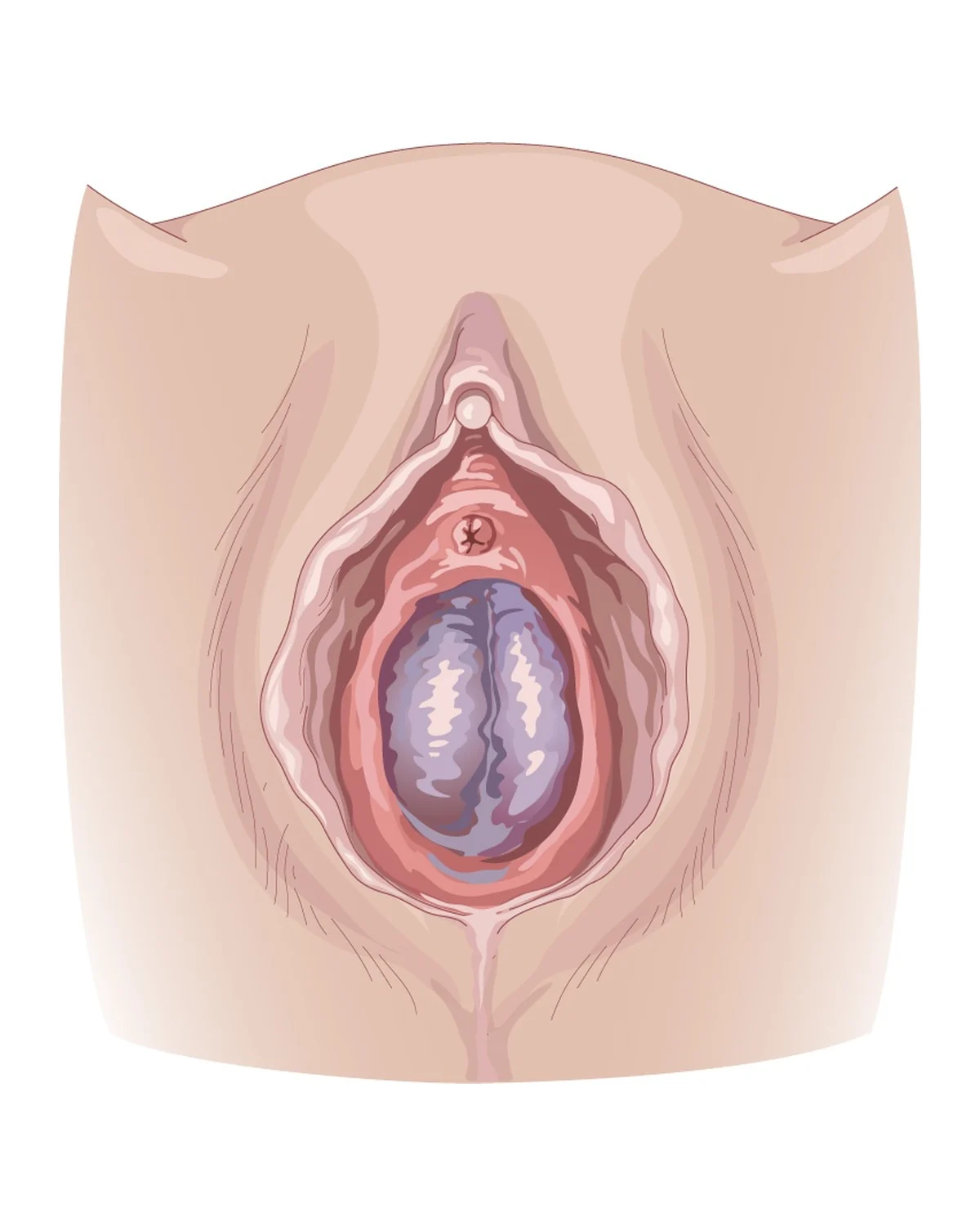 Haematocolpos — Imperforate hymen: retained menstrual blood distends the vagina; treatment is incision of the hymen.