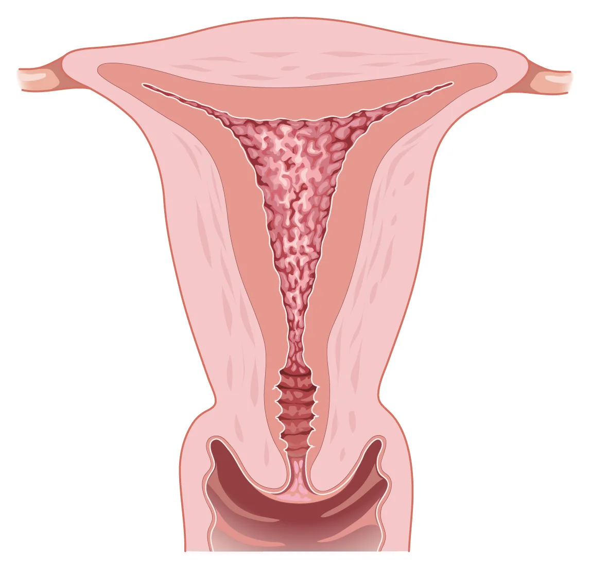 Endometrial hyperplasia — The lining of the womb is abnormally thick, which shows as increased thickness on ultrasound.