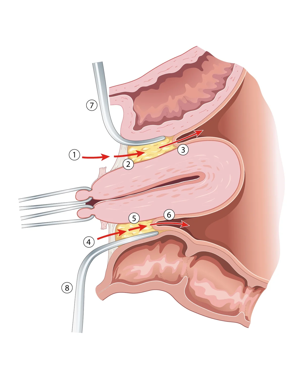 Vaginal hysterectomy: opening the pouches — Cervix held by a tenaculum; the vesico-uterine and recto-uterine pouches are opened (numbered steps) before the pedicles are divided.