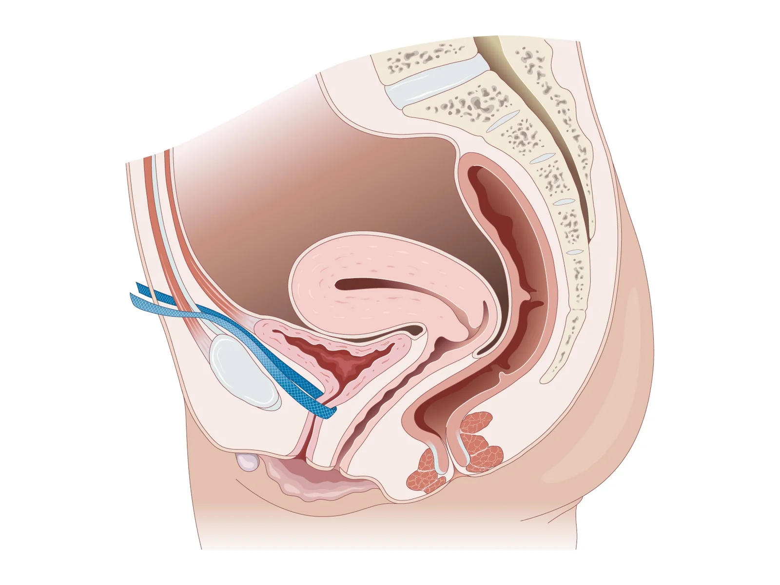 Stress incontinence treated by sling — During exertion, the mid-urethral sling provides a backstop that closes the urethra.