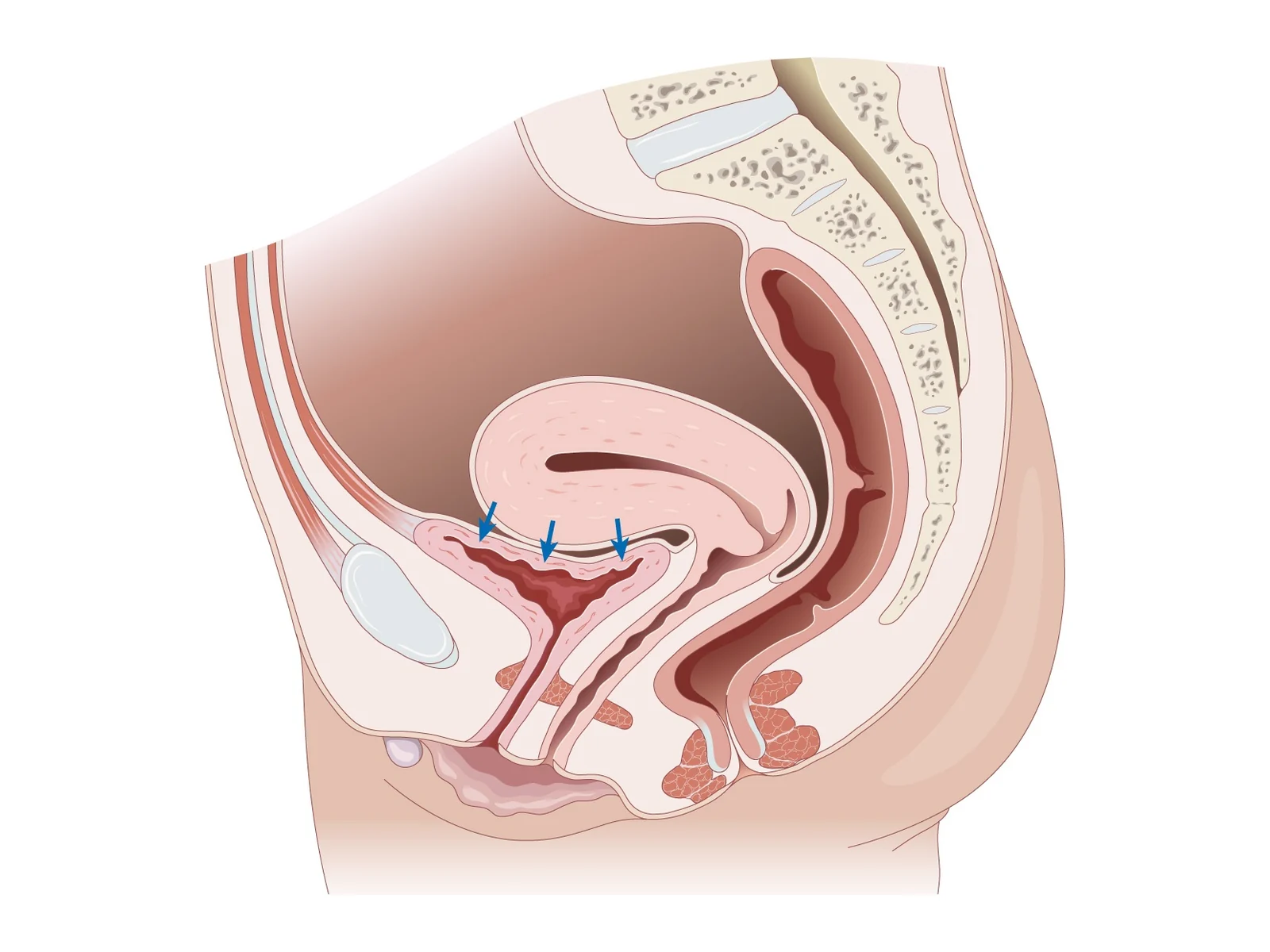 Mécanisme de l'incontinence d'effort — La pression abdominale (flèches) comprime la vessie ; sans soutien urétral suffisant, l'urine s'échappe.