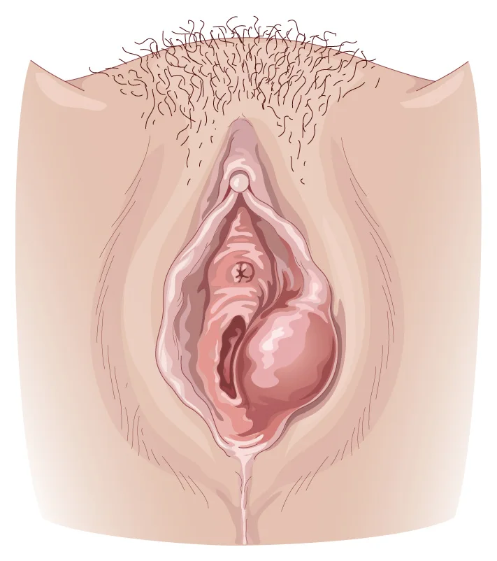Kyste de la glande de Bartholin — Tuméfaction de la partie basse d'une grande lèvre.