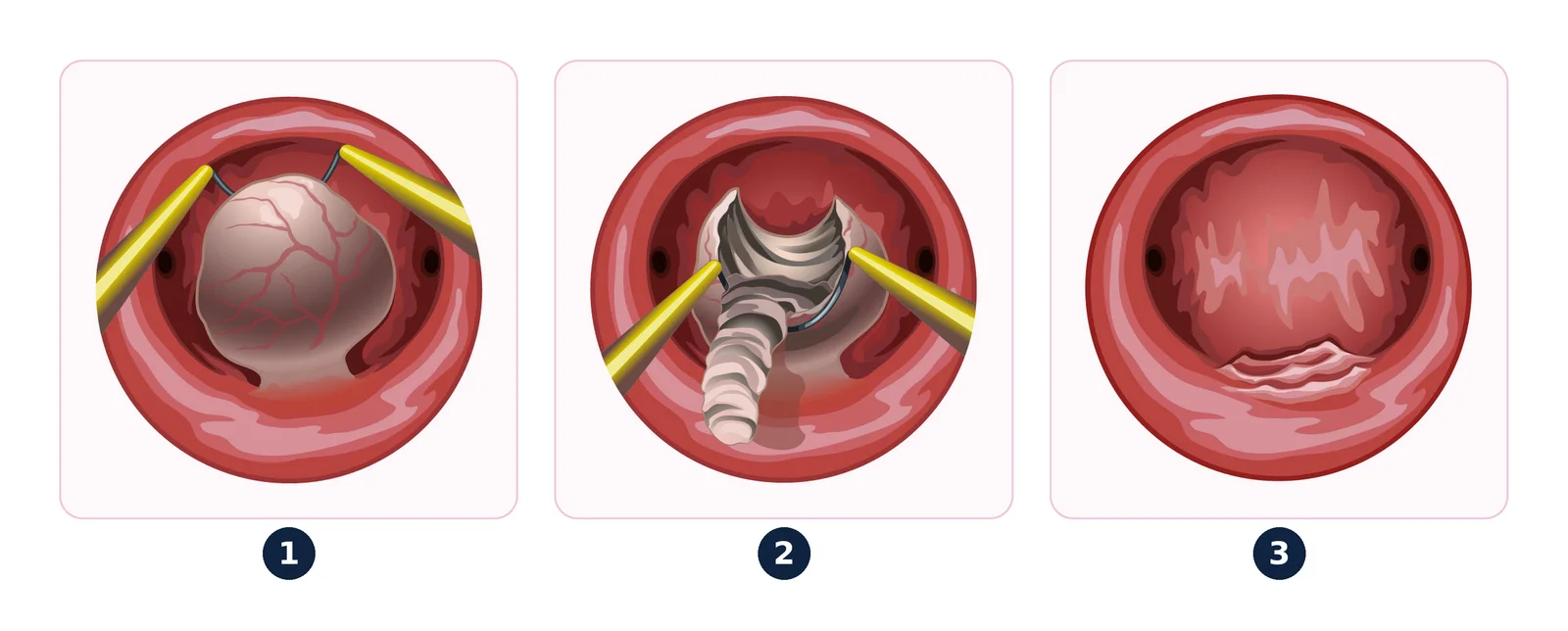 Hysteroscopic myomectomy — The submucosal fibroid (1) is shaved away with an electric loop (2) until the cavity is smooth again (3).