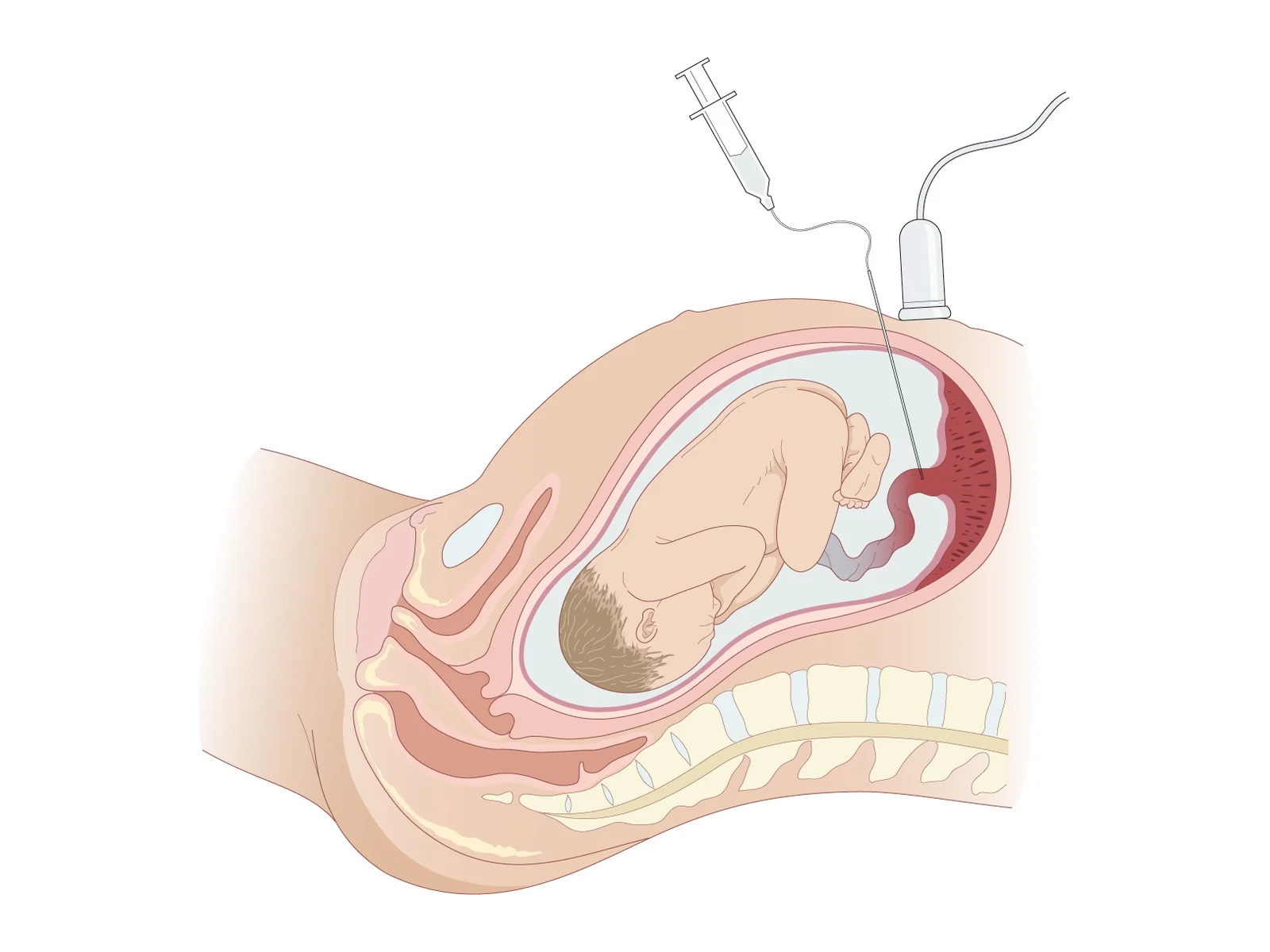Foetal blood sampling — Umbilical vein puncture (cordocentesis) under ultrasound guidance at the placental cord insertion.