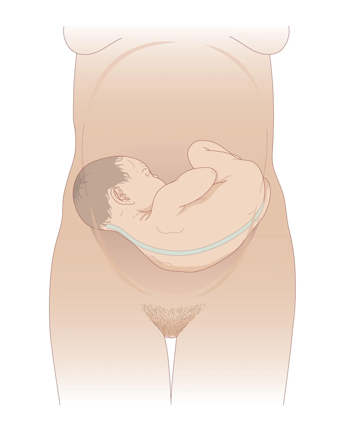 Présentation transversale dorso-antérieure — Fœtus en travers, dos tourné vers l'avant : l'accouchement par voie basse n'est pas possible en l'état.
