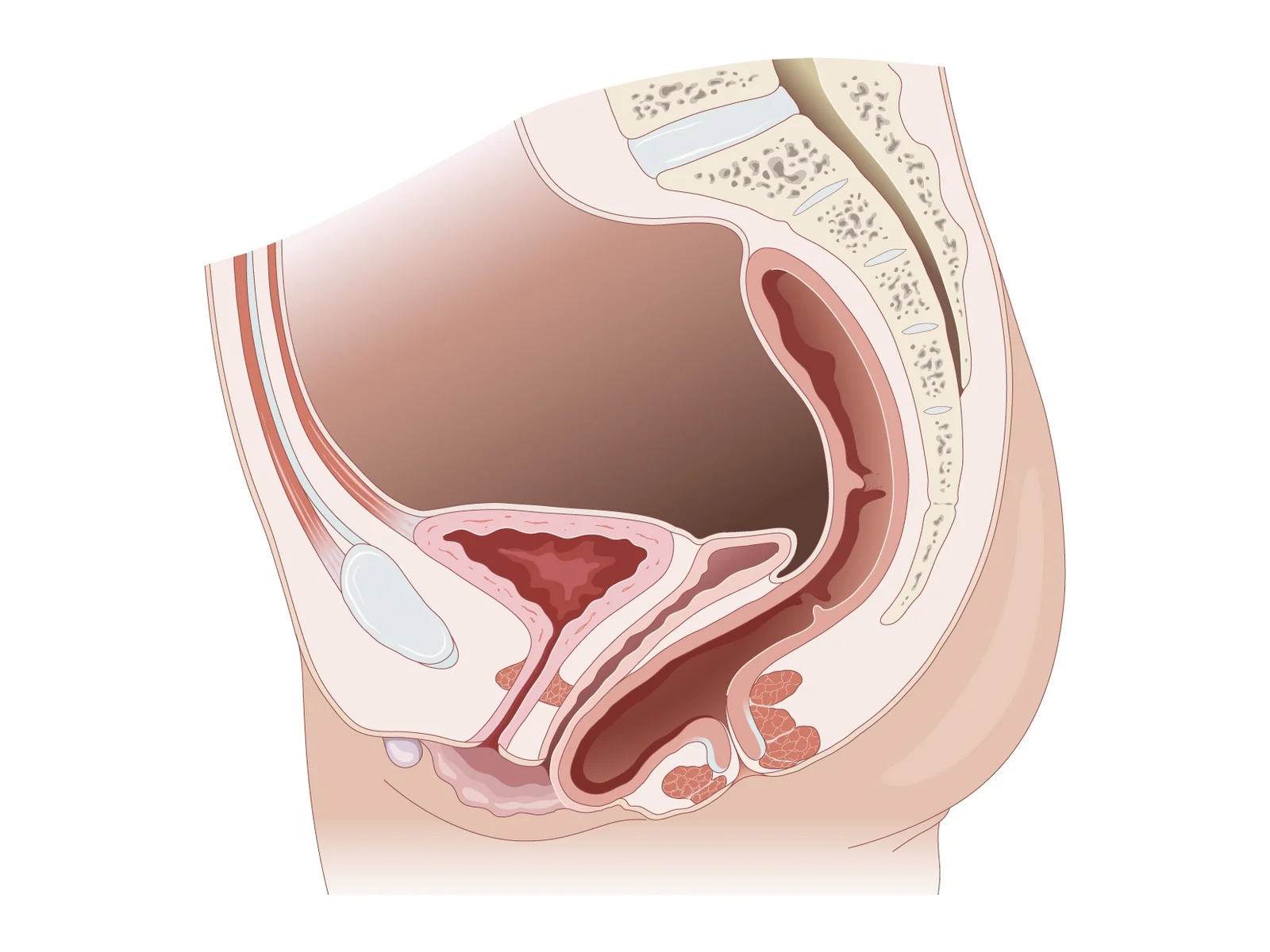 Prolapsus de la paroi postérieure — Coupe sagittale : le rectum bombe dans la paroi vaginale postérieure (rectocèle).