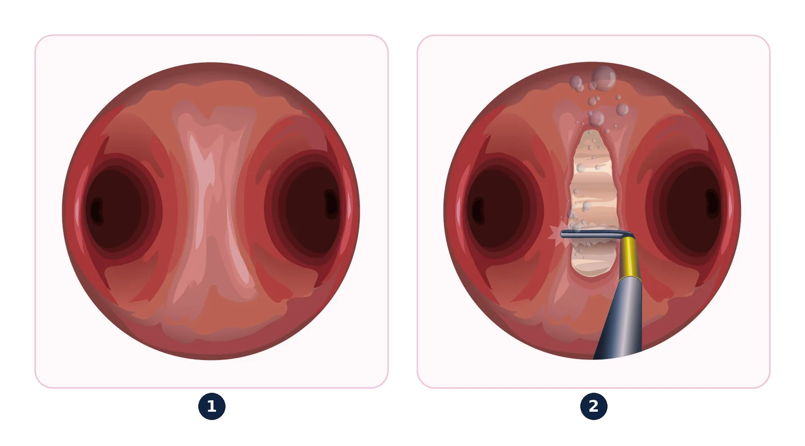 Hysteroscopic division of a septum — The septum divides the cavity in two (1); it is cut from below upwards to the top of the uterus (2).