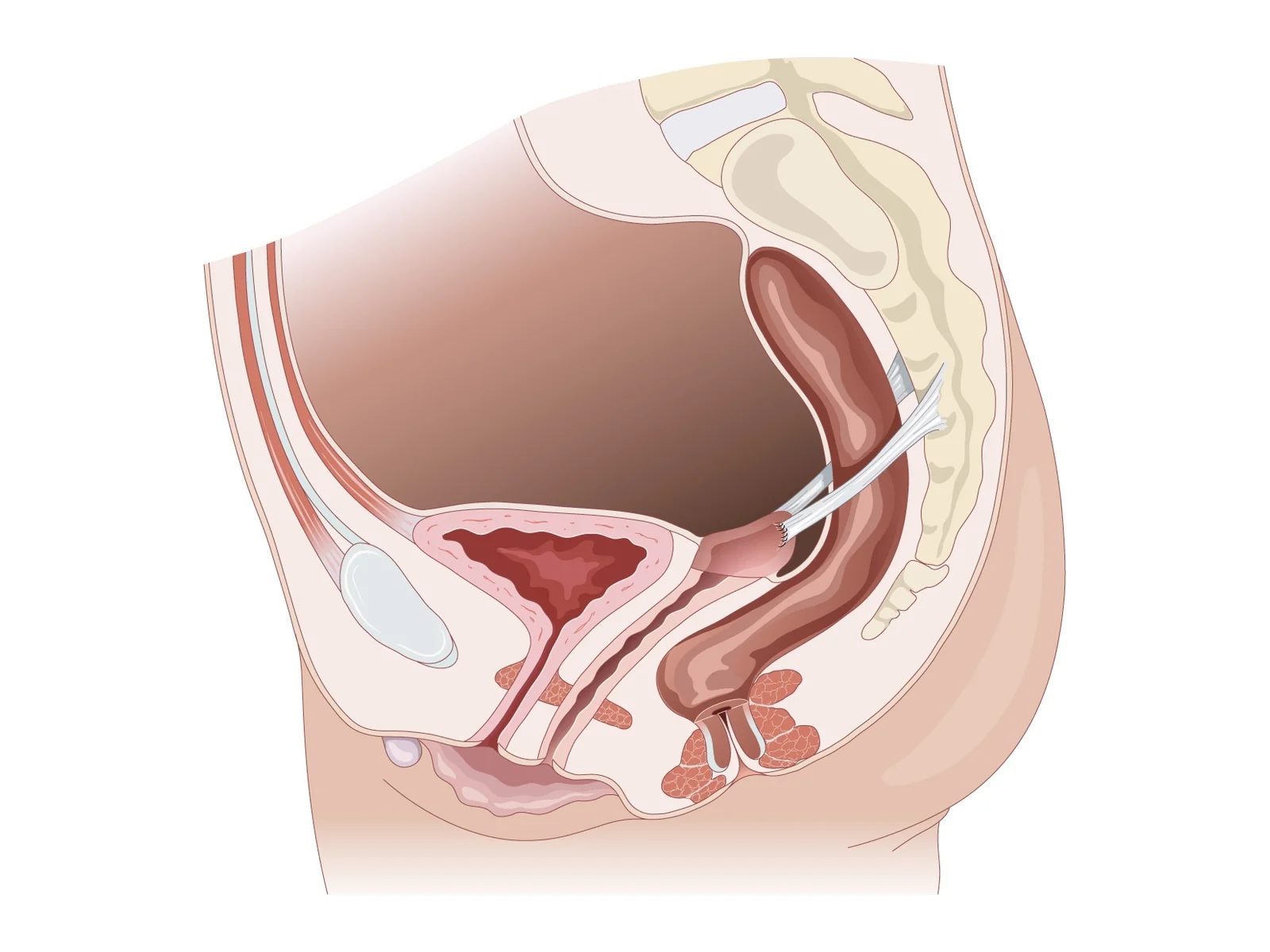 Suspension utéro-sacrée — Le fond vaginal est amarré aux ligaments utéro-sacrés pour corriger un prolapsus de l'apex.