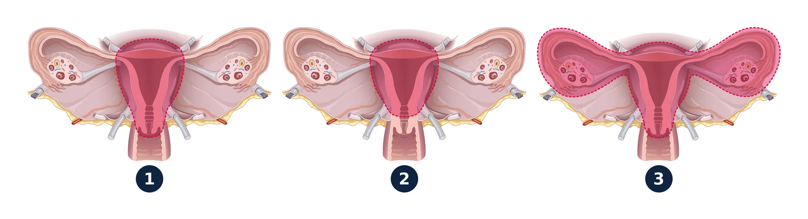 Types of hysterectomy — Area removed shown dotted: total, womb and cervix (1); subtotal, cervix kept (2); with adnexectomy, tubes and ovaries removed (3).