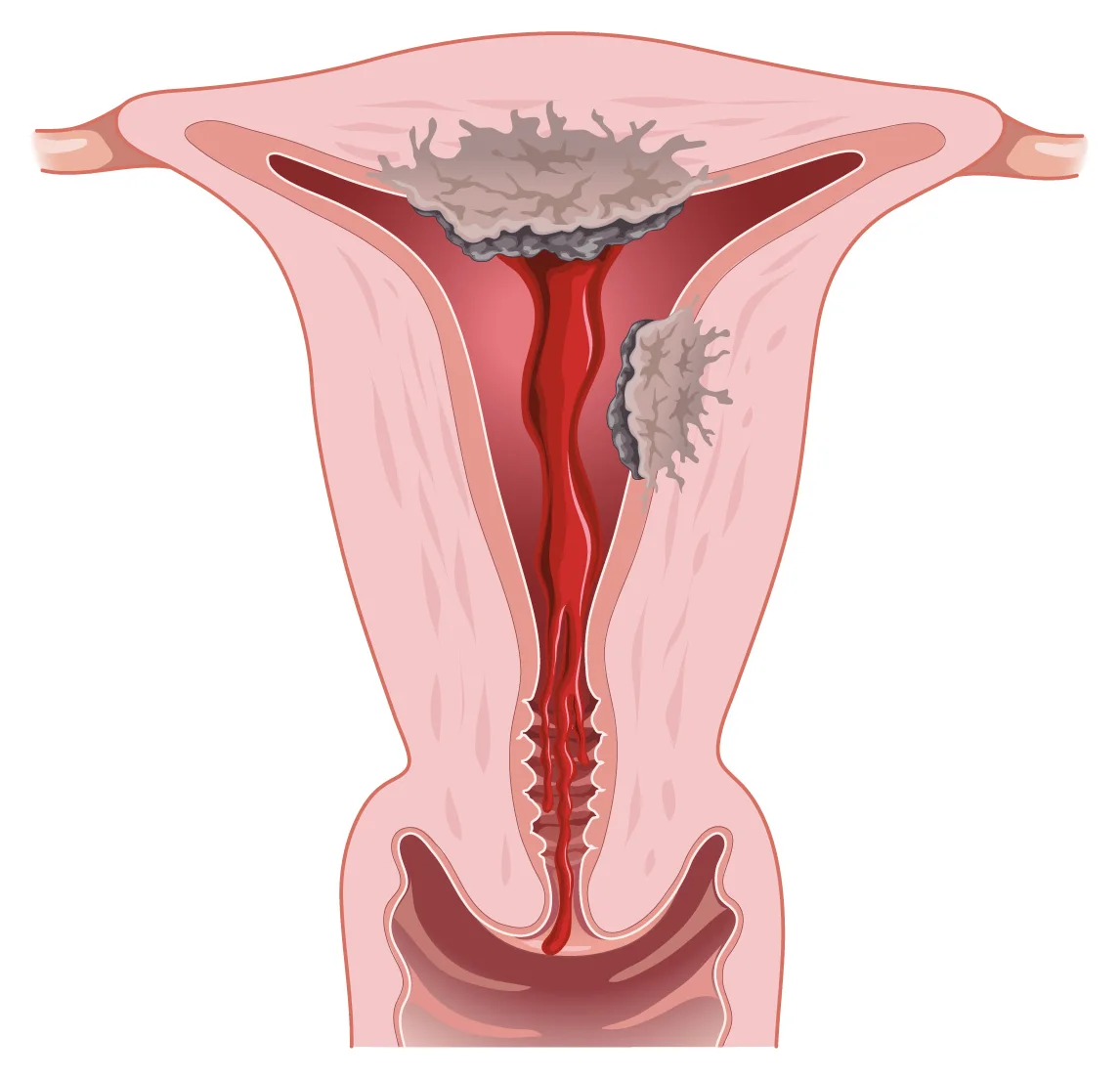 Cancer de l'endomètre — Tumeur développée à partir de la muqueuse qui tapisse la cavité utérine, responsable de saignements.
