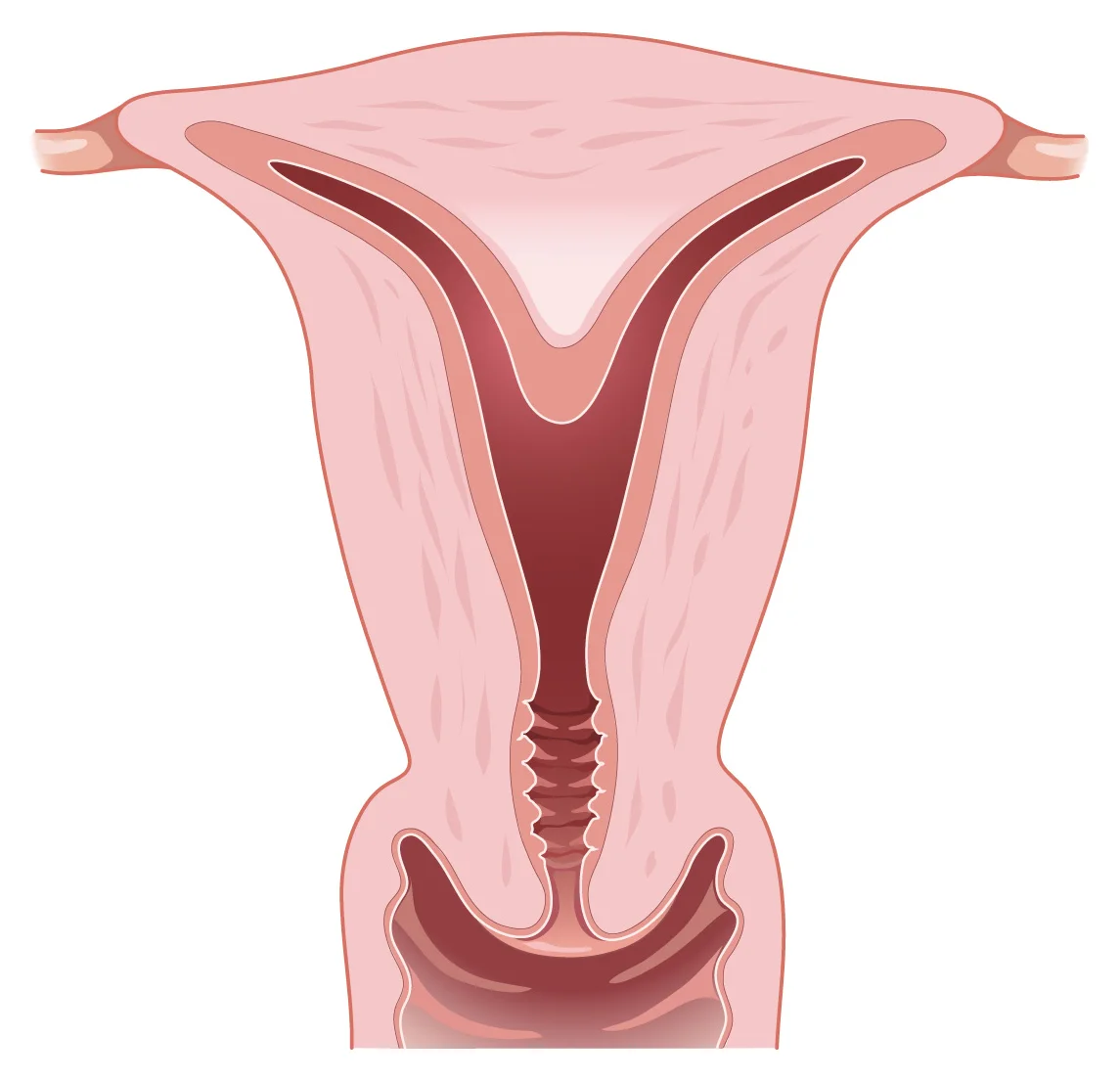 Septate uterus — A septum runs down from the top of the uterus and partly divides the cavity; the outer contour is normal.