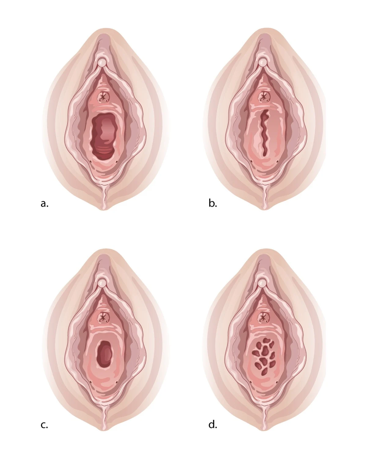 Variations anatomiques de l'hymen — Plusieurs aspects normaux de l'orifice hyménéal (a à c) et hymen cribriforme (d). L'hymen imperforé, plus rare, retient le sang des règles.