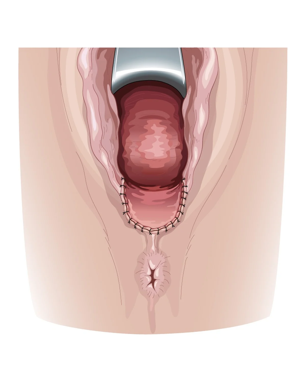 Vulvo-périnéoplastie (2) — Fermeture de la muqueuse vaginale et de la peau périnéale après reconstruction.